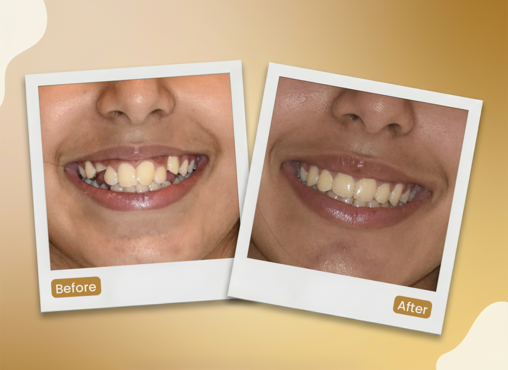 Invisalign treatment in gurugram